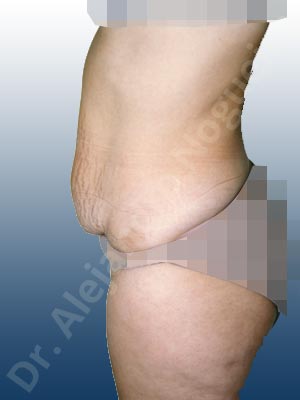 Abdomen con debilidad muscular,Abdomen descolgado,Abdominoplastia estándar