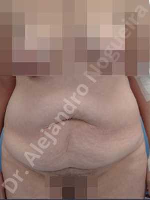 Abdomen descolgado,Abdomen con debilidad muscular,Abdominoplastia estándar