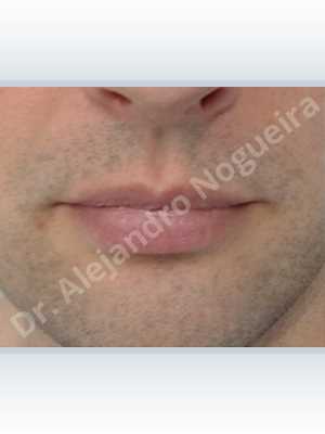 Labios pequeños,Labios transgénero,Relleno con colágeno dérmico autólogo de labio superior