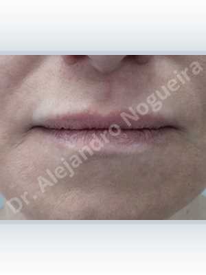 Labios pequeños,Relleno con colágeno dérmico autólogo de labio inferior,Relleno con colágeno dérmico autólogo de labio superior