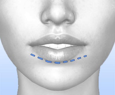 scars cheekbone augmentation