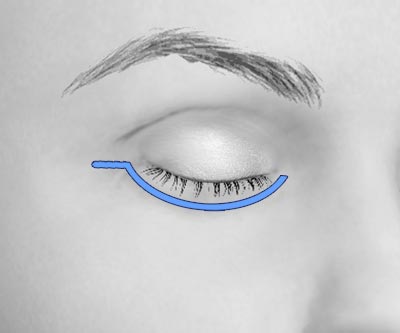 scars lower eye bags blepharoplasty - II