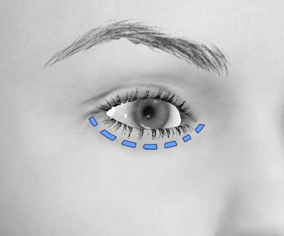 scars lower eye bags blepharoplasty - III