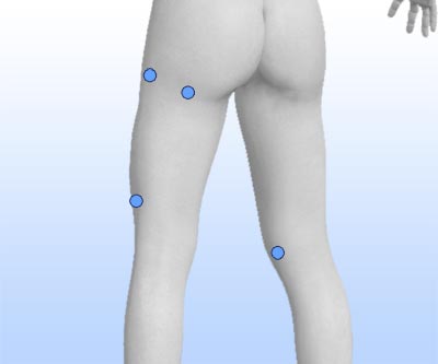 scars thigh liposuction rear